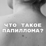 что такое папиллома