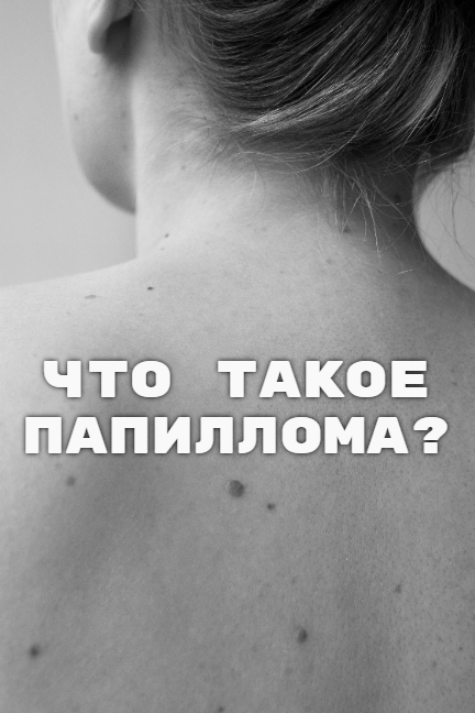 что такое папиллома